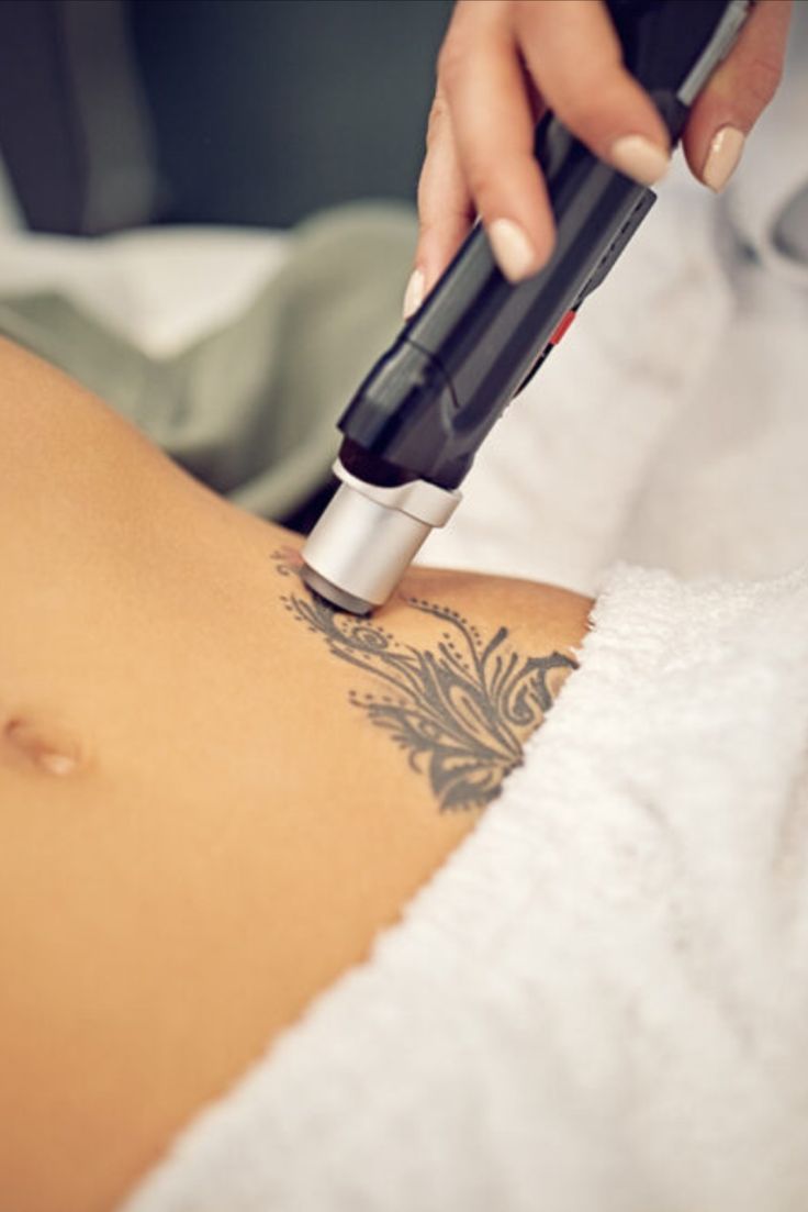 Eliminación tatuaje con láser